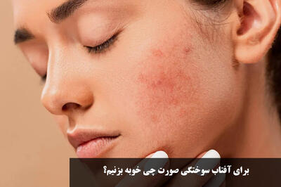 برای آفتاب سوختگی صورت چی خوبه بزنیم؟ درمان خانگی و سریع آفتاب سوختگی