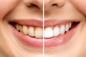 رنگ دندان چه چیزهایی درباره سلامت شما می‌گوید؟