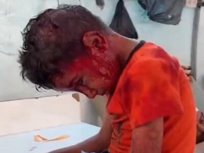 کودک مجروح فلسطینی در غزه که دیگر حتی نای گریه کردن هم ندارد