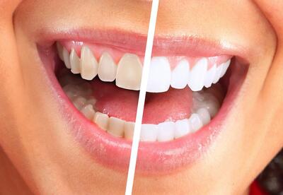 رنگ دندان ها چه چیزی درباره سلامت شما می‌گوید؟ | خطرناک ترین لکه چه رنگی است؟