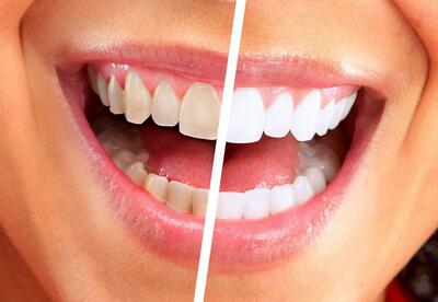 افشای رازهای مهم سلامتی شما با رنگ دندان هایتان/ خطرناک ترین لکه چه رنگی است؟