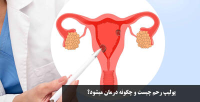 پولیپ رحم چیست و چگونه درمان میشود؟ خطرناکه؟ روش پاکسازی رحم از پولیپ