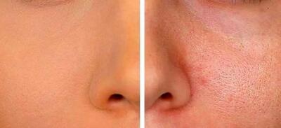 چگونه منافذ پوست را ببندیم؟ | راهکارهای خانگی و تخصصی برای بستن منافذ پوست
