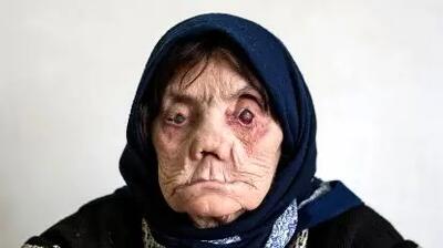 بازیگرانی که با بیماری جذام جلوی دوربین رفتند؛ لحظه‌ای باورنکردنی از المیرا دهقانی تا دیگر ستارگان + عکس