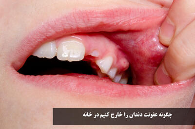 چگونه عفونت دندان را خارج کنیم در خانه | برای عفونت دندان چی بخوریم درمان خانگی و قرص