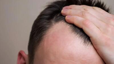 چه زمانی ریزش مو طبیعی نیست؟