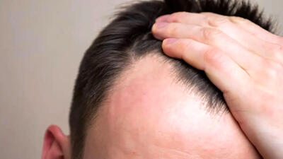 چه زمانی ریزش مو طبیعی نیست؟