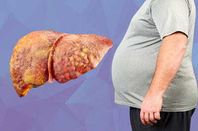 یک داروی ضد چاقی علیه کبد چرب