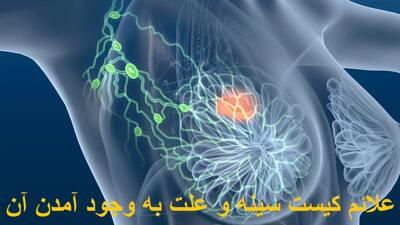 علائم کیست سینه و علت به وجود آمدن آن + برای کیست سینه چه بخوریم؟