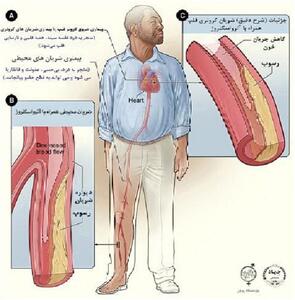 امکان تشخیص زودهنگام بیماری شریان محیطی در پژوهشگاه رویان فراهم شد