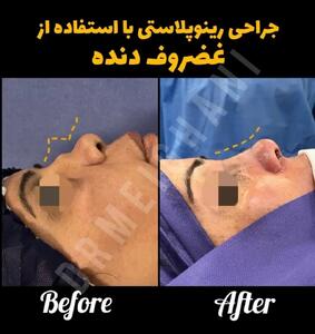 اصلاح فرم بینی با جراحی بدون بیهوشی