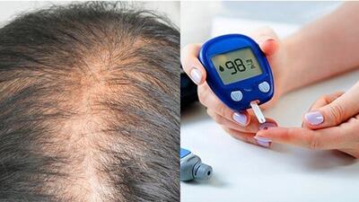 ارتباط دیابت با ریزش مو |  انصاف نیوز