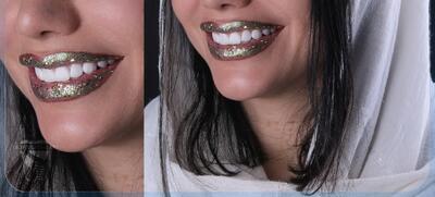 ایا میتوان همه دندان ها را با هم لمینت و ایمپلنت کرد؟