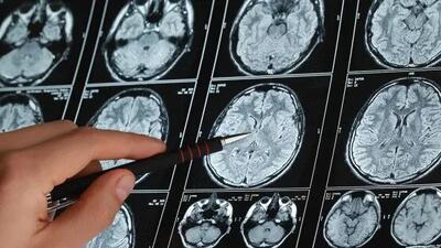 پیشگیری از آلزایمر از امروز آغاز می‌شود، نه بعد از ۶۵ سالگی