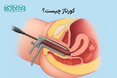 کورتاژ چیست؟ از روش انجام تا ۲ دلیل شایع + عوارض و نکات مراقبتی بعد از آن