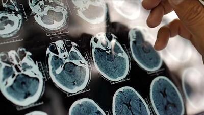 تشخیص زودهنگام آلزایمر در افراد با گوشی و ساعت هوشمند
