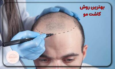 کاشت مو بدون جراحی؟ حقیقت روش‌های کم‌تهاجمی و مزایا و معایب شان
