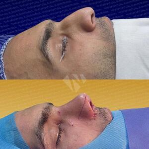 جراحی بینی استخوانی: مزایا، معایب و نتایج آن |  انصاف نیوز