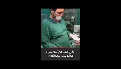 حیرت و ناباوری کادر پزشکی کهنوج در مواجهه با کرم غول‌پیکر معده مرد افغان؛ داستانی باورنکردنی