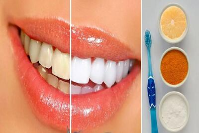 سفید کردن دندون ها با مواد طبیعی و در عرض 20 دقیقه؛ بلیچینگ بی خطر و خونگی