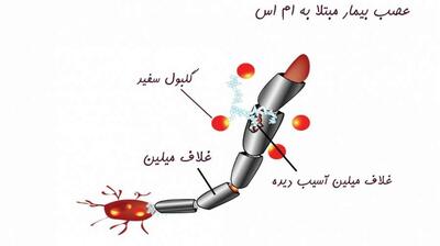 میگنا - ام‌اس؛ بیماری جوانان با ۱۰ نشانه خاموش