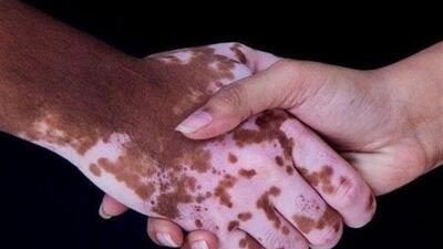 تولید موفق سرم کاهنده لک‌های پوستی در ایران برای مبتلایان پیسی