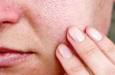 با منافذ باز پوست چه کنیم؟