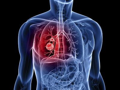 سرطان ریه؛ علل، پیشگیری، رژیم غذایی و زمان مراجعه به پزشک