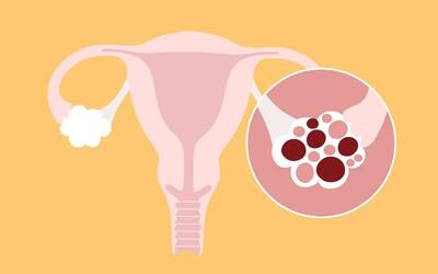 سندروم تخمدان پلی کیستیک (PCOS) و روش های درمان