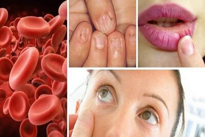 نکاتی درباره کم‌خونی و عوارض آن