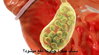 سنگ صفرا چگونه دفع میشود؟ سنگ کیسه صفرا از طریق ادرار دفع میشود یا مدفوع؟