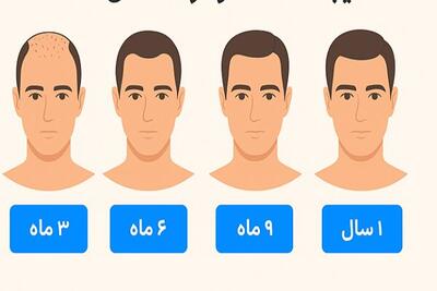 نتیجه کاشت مو بعد از چند ماه مشخص می‌شود؟