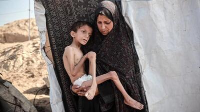 عکس/ تصاویری دردناک از سوءتغذیه کودک ۱۰ ساله اهل غزه