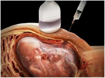 اگر در غربالگری کودک سندرم داون داشت، مجوز سقط صادر می شود؟
