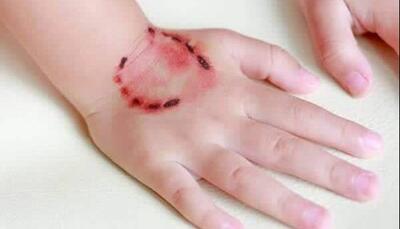 پیگیری قضایی حادثه حمله سگ به کودک 4 ساله در شوش