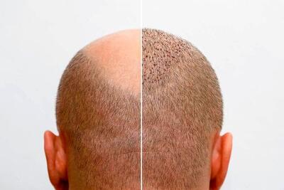 بهترین کلینیک‌های کاشت مو در کرج+ معرفی 10 کلینیک برتر