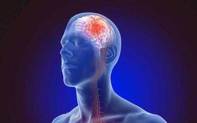 علائم اولیه سکته مغزی؛ دلایل از فشار خون تا مصرف الکل و سیگار