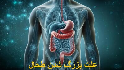 علت بزرگ شدن طحال در زنان و مردان؛ خطرناک است؟ قابل درمان است؟