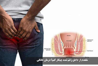 مقعدم زخم شده چیکار کنم؟ درمان خانگی و پماد زخم مقعدی در اثر یبوست