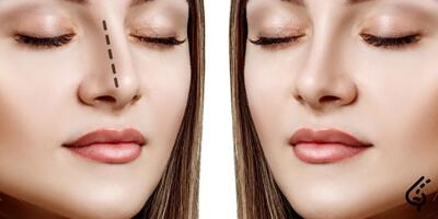روش‌های جدید عمل بینی بدون عمل جراحی