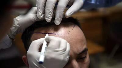 چگونه استانبول به پایتخت کاشت موی جهان بدل شد؟