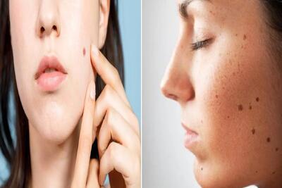 از بین بردن خال های صورت و بدن در خانه و با استفاه از مواد طبیعی؛ با سرکه سیب حلش کن