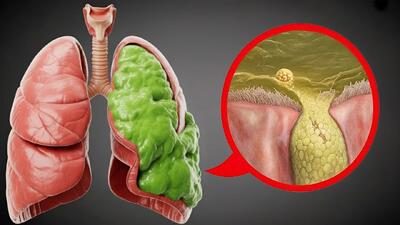 با این ادویه قدیمی خلط ریه را سریع و طبیعی از بین ببرید