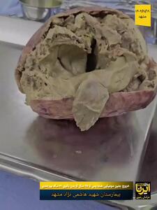خارج کردن جنین ۳۵ ساله مومیایی از رحم یک زن!