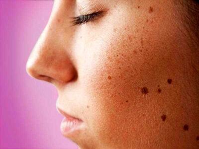جای اسکار سالک با چه روش‌هایی انجام می‌شود + معرفی بهترین روش
