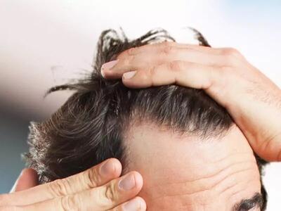 چطور از موخوره پیشگیری کنیم؟ | راز موهای درخشنده و با طراوت با این چند روش ساده