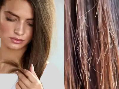 چگونه از موخوره جلوگیری کنیم؟