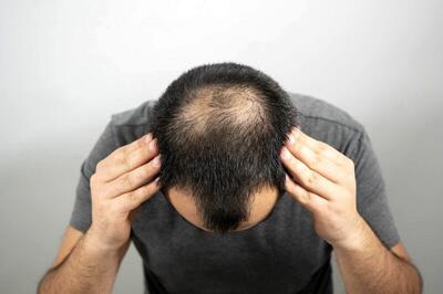  این شیرین کننده طبیعی از کچل شدن شما جلوگیری می کند