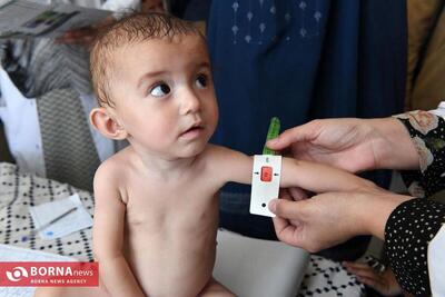  کاهش چشمگیر سوء تغذیه در کودکان زیر پنج سال استان البرز