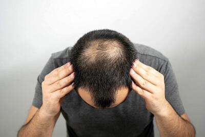 این شیرین کننده طبیعی از کچل شدن شما جلوگیری می کند